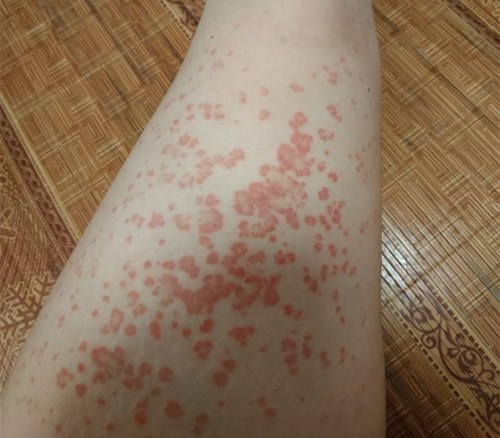 卿勇進(jìn)行雙眼皮手術(shù)的評估和價(jià)格參考