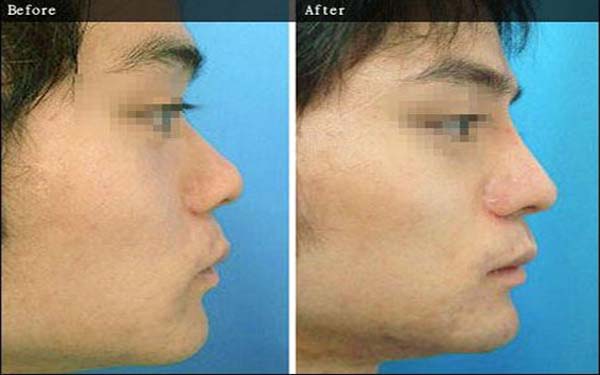 安徽省立醫(yī)院雙眼皮整形專家排行榜丨手術(shù)費(fèi)用詳解丨經(jīng)典案例分享