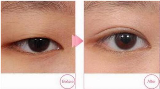 寧波哪家醫(yī)院做韓式雙眼皮效果好？