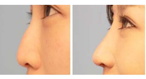 大連瑞和醫(yī)療美容醫(yī)院受歡迎嗎？楊檸澤做雙眼皮效果怎樣？真實網(wǎng)友體驗來了解！