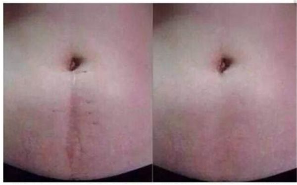 深圳哪家醫(yī)院專業(yè)治療傷疤效果好？