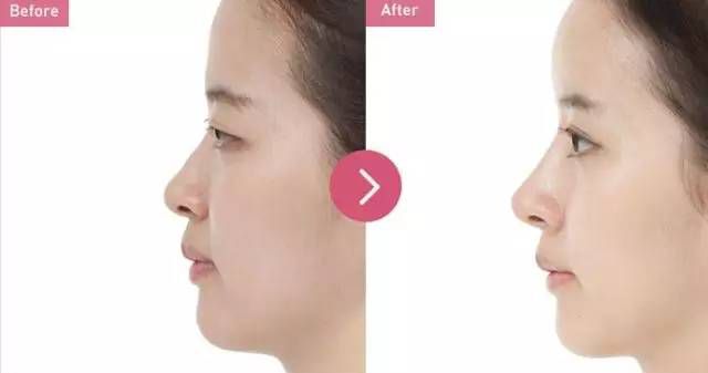 2023長(zhǎng)沙肉毒素注射魚尾紋權(quán)威醫(yī)生上榜前十強(qiáng)(吳蒙、彭浩、亓發(fā)芝值得了解！)