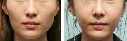 重慶雙眼皮整形醫(yī)院評(píng)價(jià)如何？哪家信譽(yù)好？