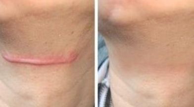 上海哪家醫(yī)院的玻尿酸鼻子效果最好？