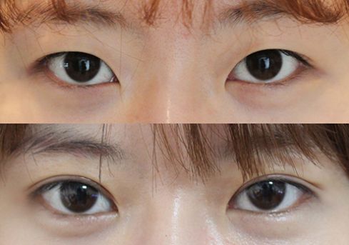 2023南昌無痕水波拉皮正規(guī)專家榜單前10名(陳奕霏、楊存昌、戴文燦技術(shù)口碑在線)