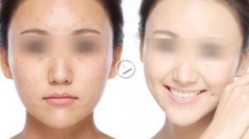 廣州哪家醫(yī)院去黑頭好？揭秘廣州專業(yè)祛黑頭效果最佳的醫(yī)療機(jī)構(gòu)