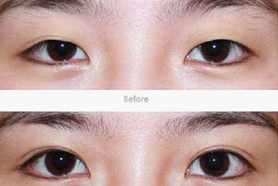 上海雙眼皮手術(shù)哪家醫(yī)院好？選擇哪家醫(yī)院最關(guān)鍵