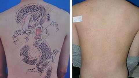 怎樣修復(fù)鄭荃疤痕，讓人滿意？