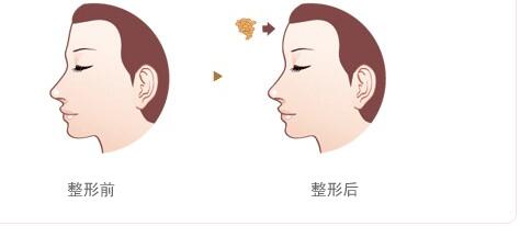 上海翡立思醫(yī)療陳立彬：無痛吸脂撇開隱患，告別粗腿不再是夢