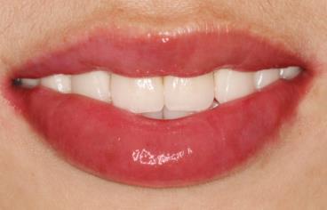 2023上海溶脂針瘦肩專家前十上榜名單(洪愷志、吳建明、陳兵技術(shù)強(qiáng)、價(jià)格低！)