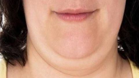 吳佳君醫(yī)生拉皮技術獨步一時，值得信賴嗎？費用如何計算？