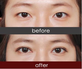 恩施市哪家醫(yī)院注射除皺針效果好推薦？