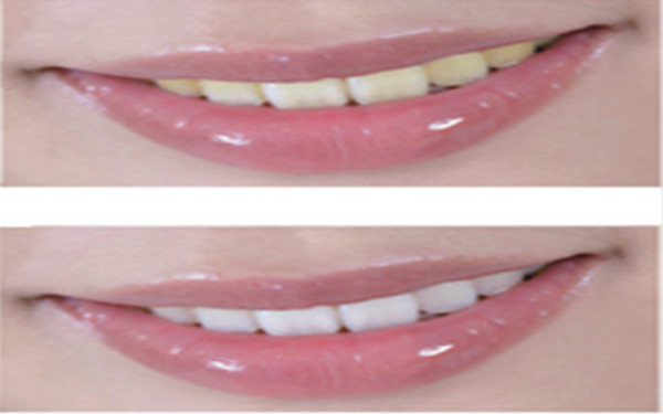 2023杭州去除雀斑皮秒祛斑權(quán)威醫(yī)生排行前十(馮文、楊連華、關(guān)石錦專業(yè)技術(shù)好！)