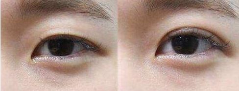 寧波市眼袋手術哪家醫(yī)院好？