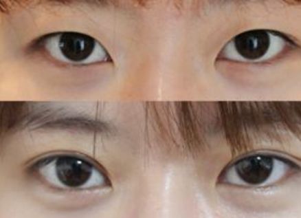 杭州去咖啡斑好的醫(yī)院有哪些？