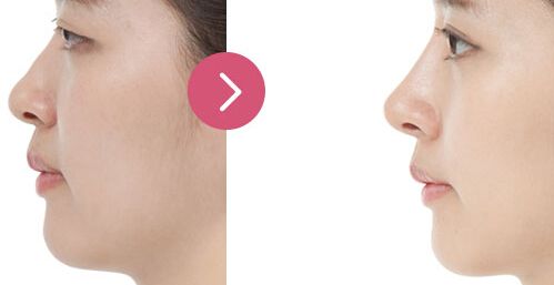 廣州哪家醫(yī)院眼部整形效果好，專業(yè)醫(yī)院推薦