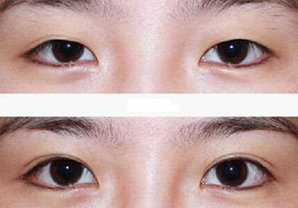 北京哪家激光祛痘醫(yī)院好？選擇正規(guī)醫(yī)療機構，實力專家團隊等你來解答