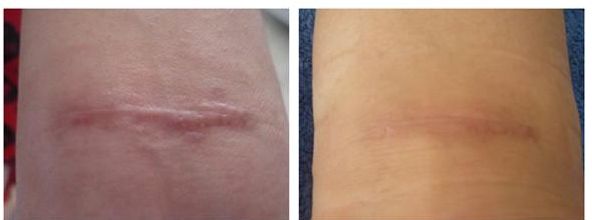 廣州治疤痕醫(yī)院專(zhuān)家推薦，哪家治疤痕效果好？