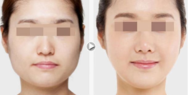 上瞼下垂矯正術(shù)的禁忌事項，你需要知道的關(guān)鍵信息