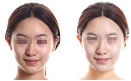 處女膜修復(fù)的方法及注意事項