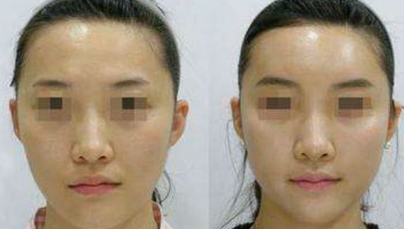 腹部脂肪去除的優(yōu)點是什么？