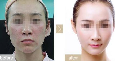 眼瞼內(nèi)翻手術(shù)的優(yōu)勢(shì)與效果