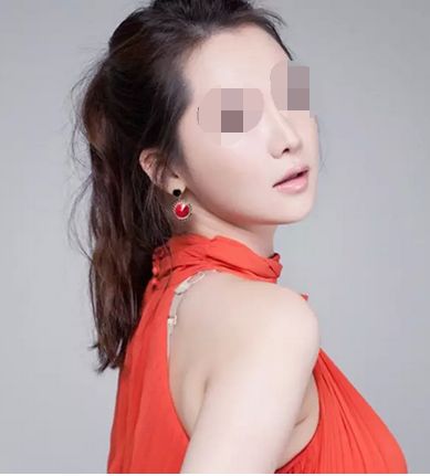 雙眼皮整形術(shù)術(shù)后需要注意些什么？