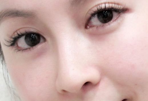 除皺手術(shù)后需注意的副作用及長期效果