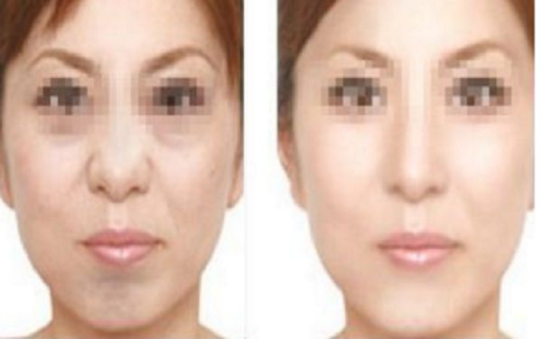 眼袋手術(shù)后疤痕何時(shí)消失？手術(shù)后禁食期應(yīng)該如何安排？