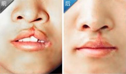 成都整形醫(yī)院隆鼻手術價格及影響因素全解析