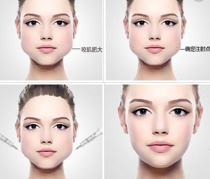 注射隆鼻的優(yōu)勢與效果全面解析