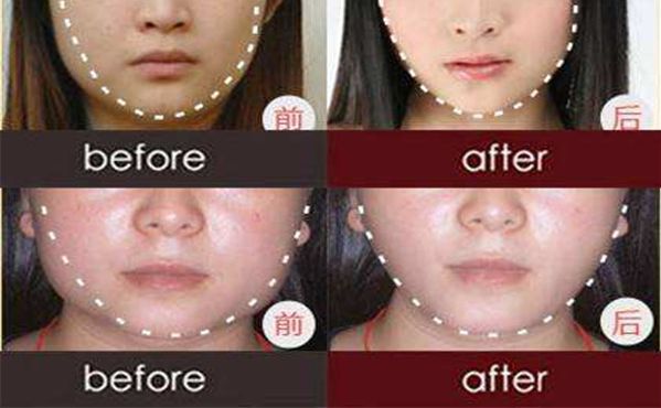 上海瑞東隆鼻注射價(jià)格查詢，鼻部整形的費(fèi)用是多少？