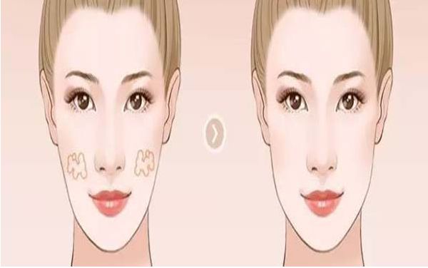 雙眼皮手術的詳細步驟及注意事項