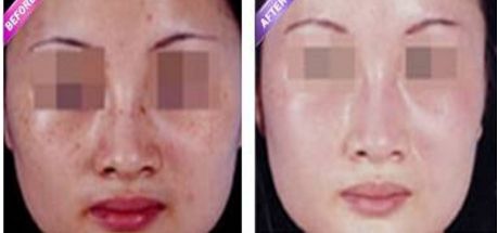 激光縮陰是否會導致副作用？找到安全有效的解決方法