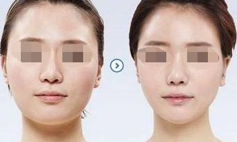 腹部吸脂：瘦腰有效的護(hù)理技巧與優(yōu)點(diǎn)