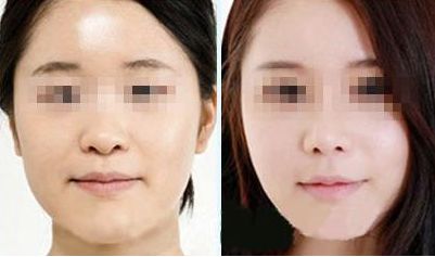 激光去除眼袋，持久效果有多久？價(jià)格如何，眼周抗衰秘笈大揭示