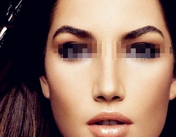 透明質(zhì)酸隆鼻后是否可以自由按壓鼻子？