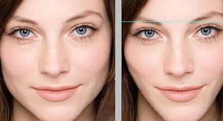 透明質(zhì)酸隆鼻：步驟詳解，效果驚艷！