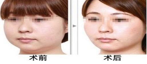 芯絲翠果酸換膚全攻略！換膚操作流程詳解，媽媽們都在搜這些步驟！