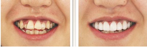 眼角修復(fù)術(shù)：哪種方法更適合您的需求？