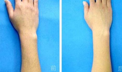 腹部吸脂手術(shù)是否存在副作用？