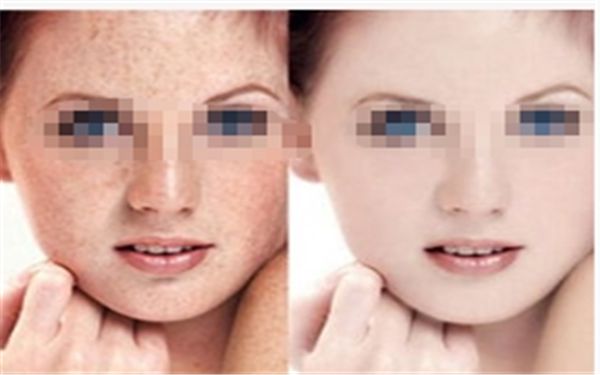 吸脂手術(shù)對(duì)于減肥有哪些顯著效果呢？