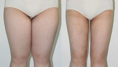 利用腹部吸脂手術塑造完美曲線