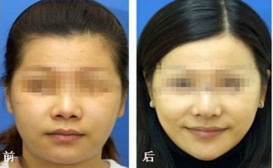 透明質(zhì)酸隆鼻價(jià)格多少？價(jià)位調(diào)查報(bào)告來襲！