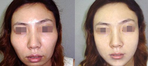 南京硅膠鼻隆和膨體鼻隆哪個更適合