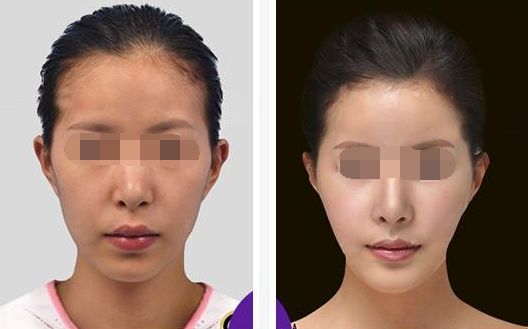 臂部脂肪減少的要點(diǎn)，匯總臂部吸脂注意事項(xiàng)