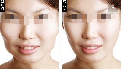 假體隆胸植入多久需要更換？