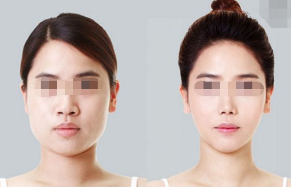 雙眼皮消腫速度？這個方法幫你快速恢復(fù)！