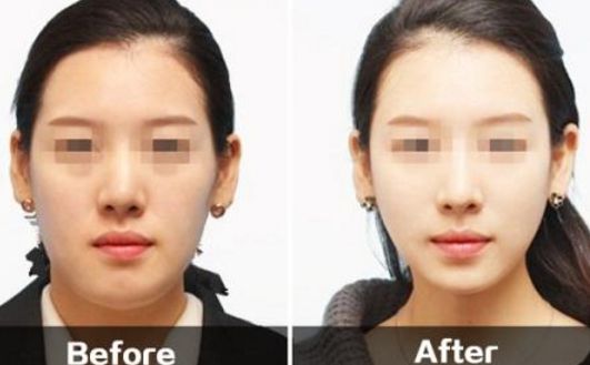 神奇的無痛拉皮術(shù)，秀出無瑕年輕面龐！點擊了解相關(guān)知識！
