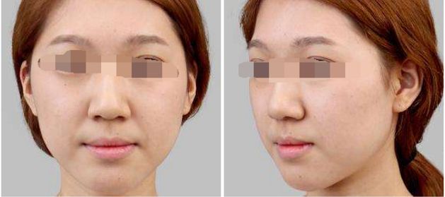 鼻子整形手術(shù)價(jià)格大揭秘！想要隆鼻手術(shù)的你，趕緊來看！